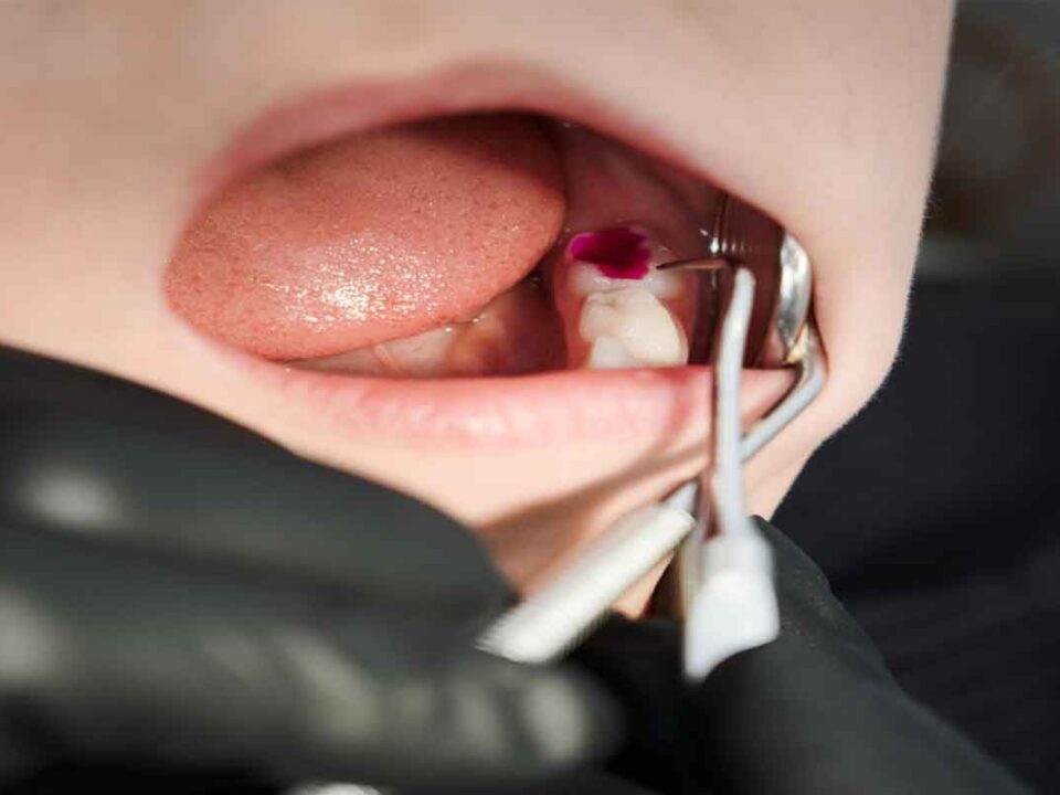 Signs Your Wisdom Teeth Need to Come Out