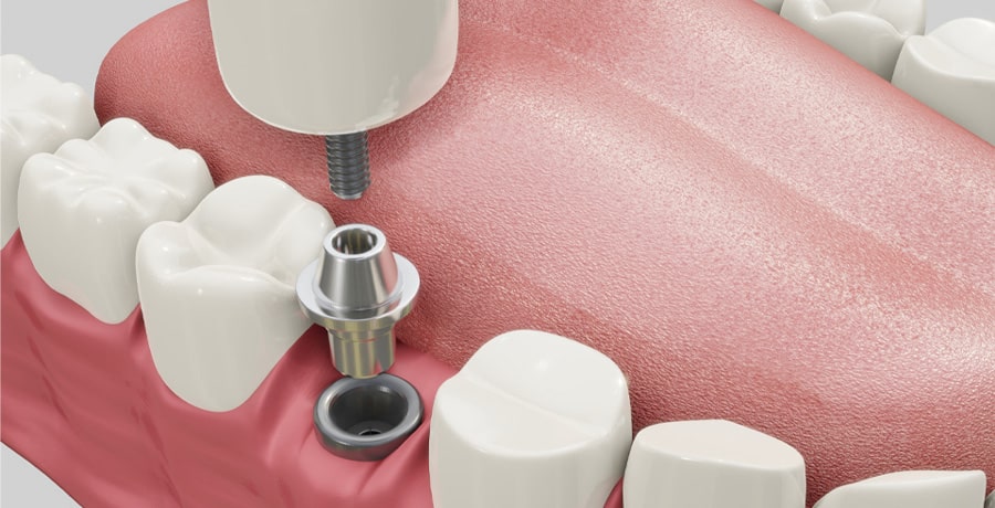 Single Tooth Implant Replacement