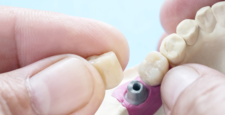 Single Tooth Implant