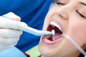 Teeth Washing Cost in Kirkland, Washington