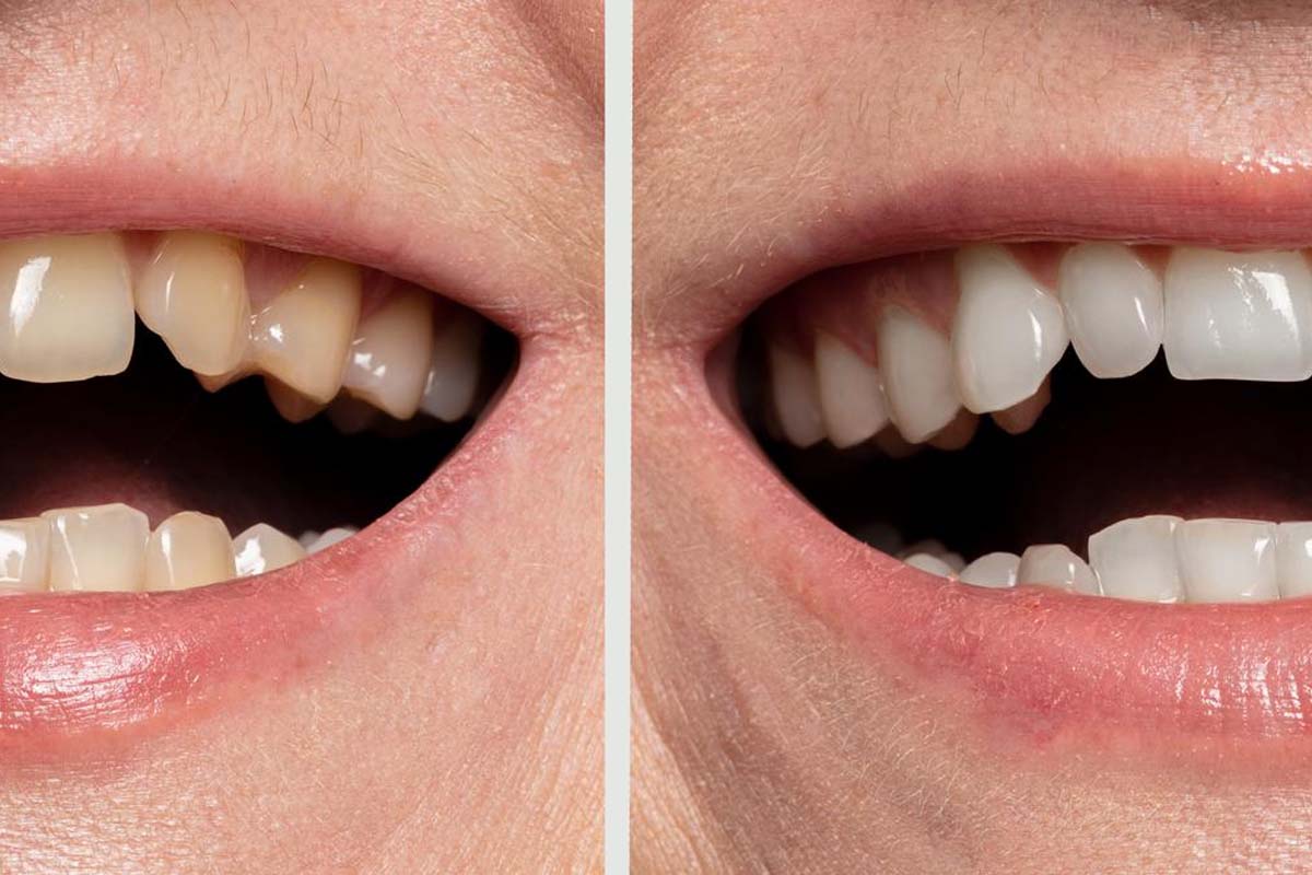 Teeth Whitening Kirkland Before After