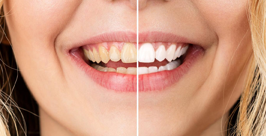 Teeth Whitening in Kirkland Before After