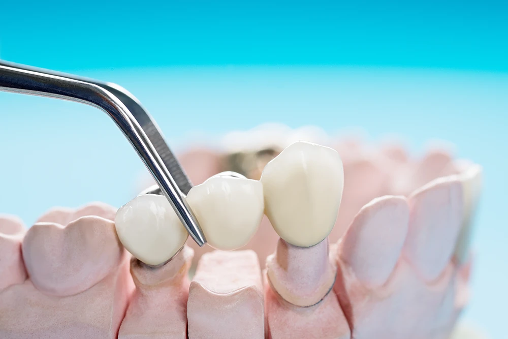 The procedure of Dental Bridge for One Tooth