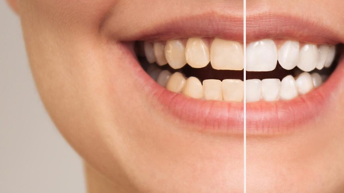 Tips for Dealing with Teeth Whitening and Tooth Sensitivity