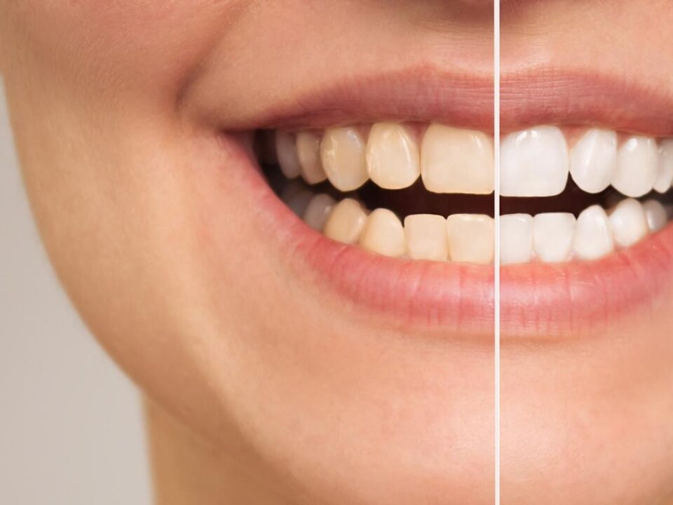 Tips for Dealing with Teeth Whitening and Tooth Sensitivity