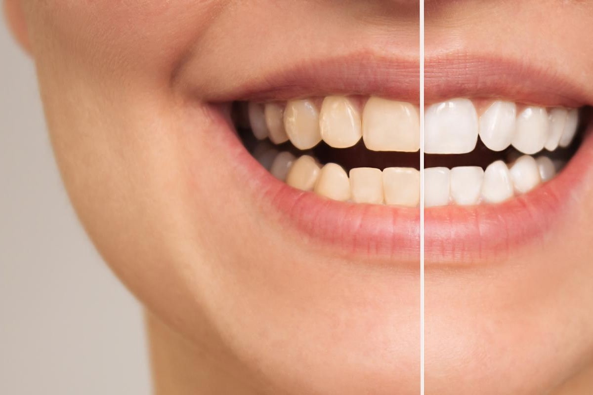 Tips for Dealing with Teeth Whitening and Tooth Sensitivity