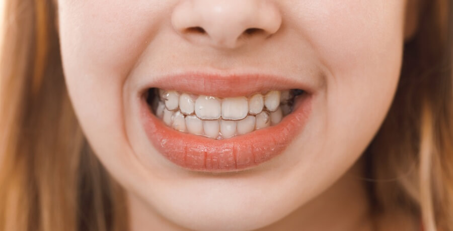 Tooth Removal for Orthodontics