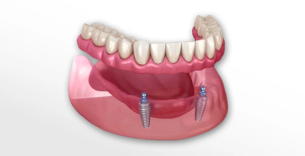 What Are Snap-on Dentures?