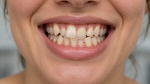 What Are the Causes of Crooked Teeth and How to Fix Them