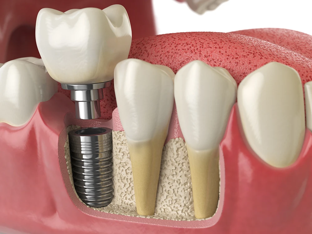 What Implants Are Not Safe for MRI?