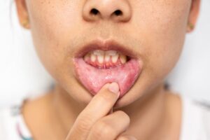 What Is the Difference Between a Mouth Ulcer and Mouth Cancer?