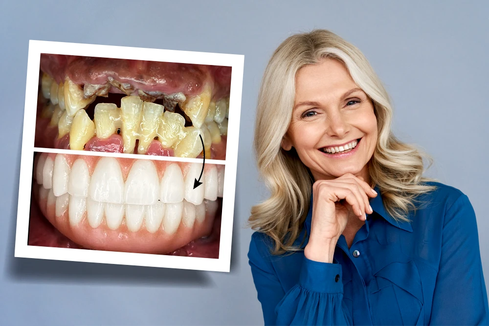 What is Full Mouth Reconstruction?