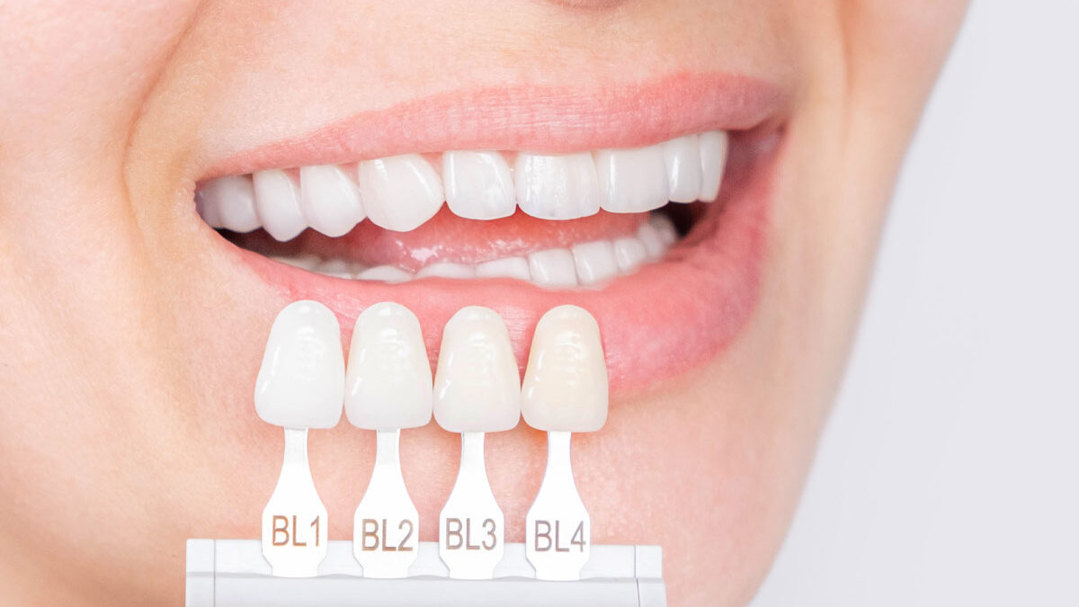 What’s The Difference Between Veneers and Lumineers?