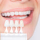 What’s The Difference Between Veneers and Lumineers?