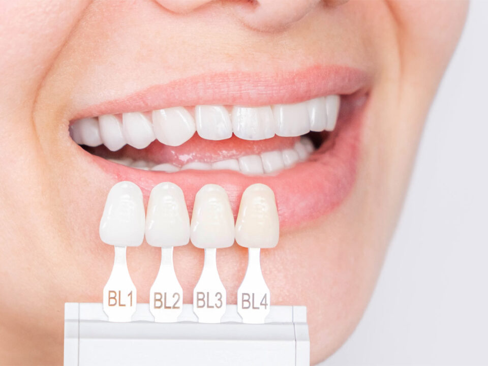 What’s The Difference Between Veneers and Lumineers?