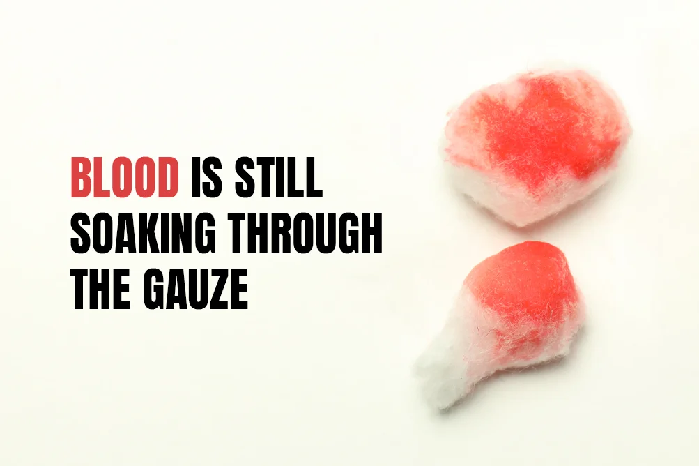 When to Keep Gauze on After Tooth Extraction?