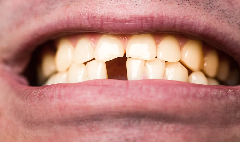 When to Use a Single Tooth Bridge?