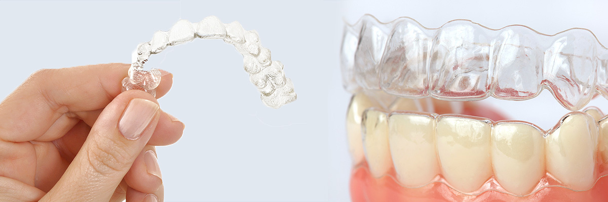 Kirkland Alternative to Braces for Teens