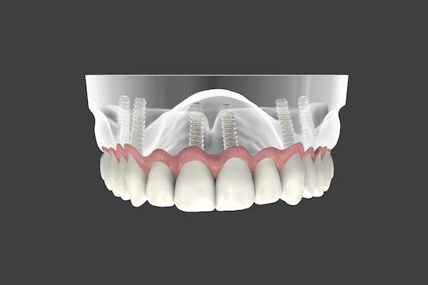 Are Implant Supported Dentures Permanent from Kirkland Dental Excellence in Kirkland, WA