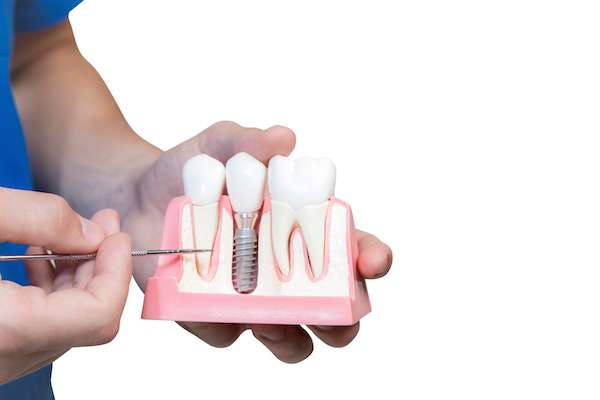 Can You Get Dental Implants if You Have Gum Disease from Kirkland Dental Excellence in Kirkland, WA