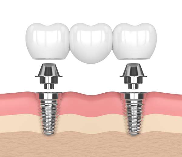 Dental Implants Kirkland, WA