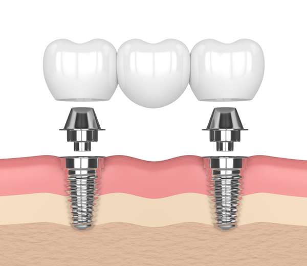 A Guide To Dental Implant Aftercare