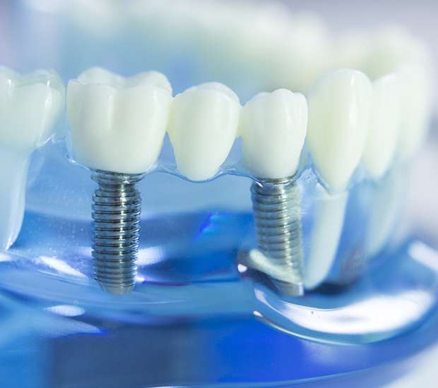 Kirkland Dental Implants