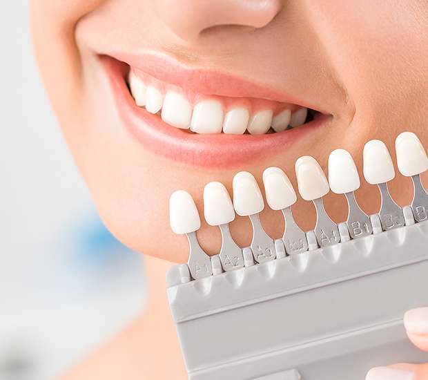 Kirkland Dental Veneers and Dental Laminates