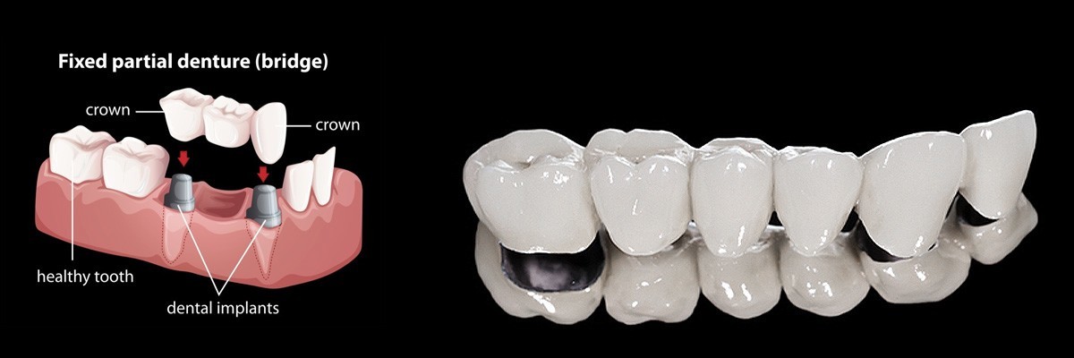 Kirkland Dentures