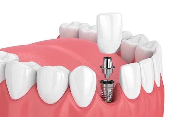 How Painful is Dental Implant Surgery from Kirkland Dental Excellence in Kirkland, WA