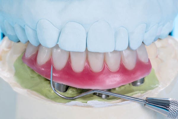 Implant Supported Dentures Kirkland, WA