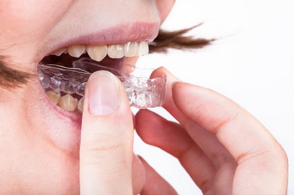 Invisalign Dentist Kirkland, WA