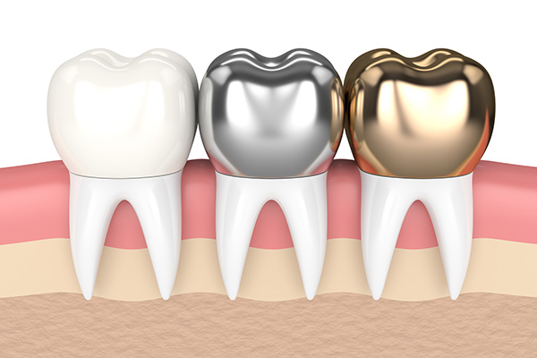Metal Crowns vs. Porcelain Dental Crowns from Kirkland Dental Excellence in Kirkland, WA