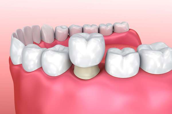 Permanent Dental Crowns vs. Temporary: Is There a Difference from Kirkland Dental Excellence in Kirkland, WA