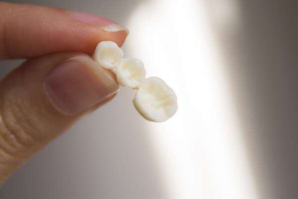 Replace Missing Teeth with Dental Bridges from Kirkland Dental Excellence in Kirkland, WA
