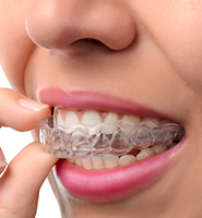Clear Aligners - Almost Invisible Braces Kirkland, WA