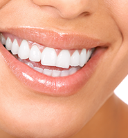 Teeth Whitening Services Kirkland, WA