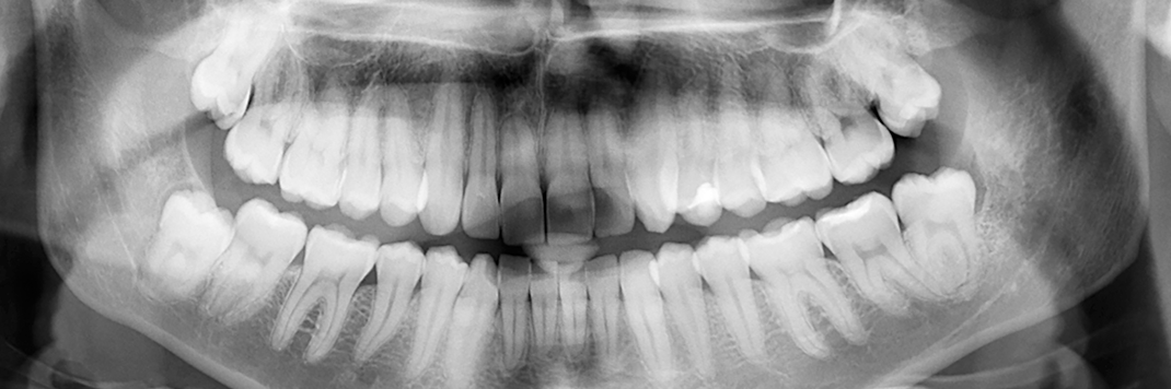 Kirkland Wisdom Teeth Extraction